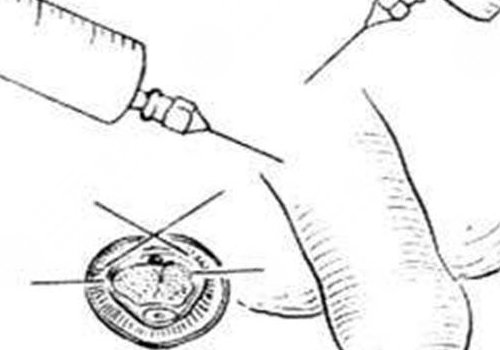 玻尿酸男性增大注射要多少錢？