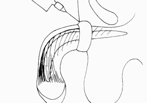玻尿酸男性增大注射要多少錢？