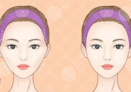 假體填充太陽凹大概多少錢？