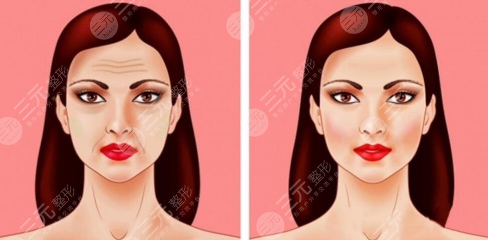 北京加減美醫(yī)院面部提升術案例