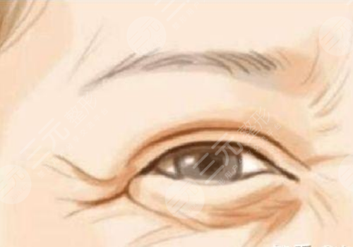 面部筋膜提升術(shù)能保持多久