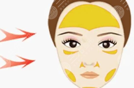 內(nèi)輪廓固定