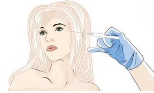 內(nèi)輪廓固定