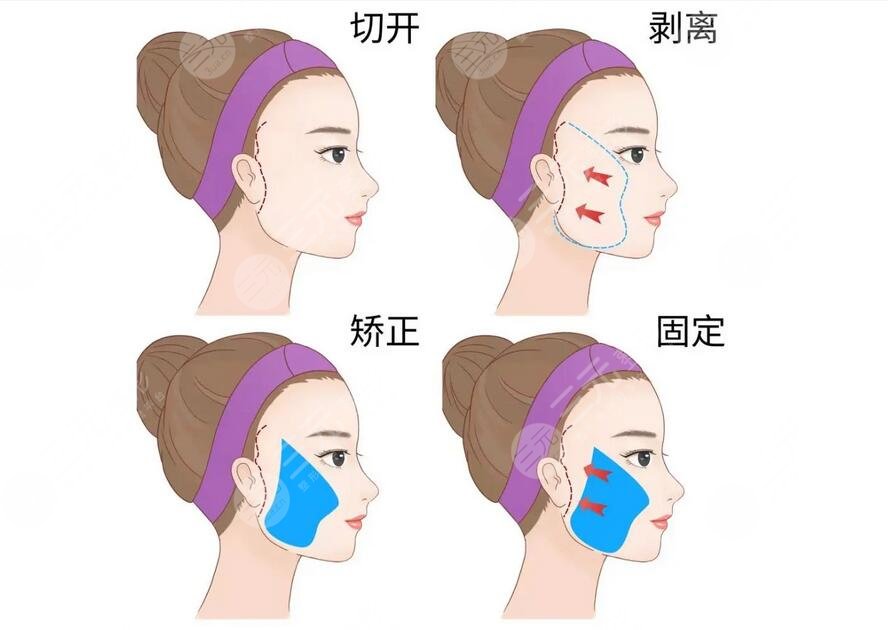 面部筋膜提升術(shù)能保持多久