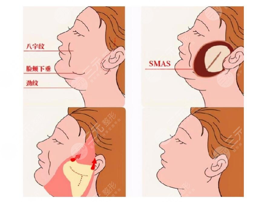 面部筋膜提升術(shù)能保持多久