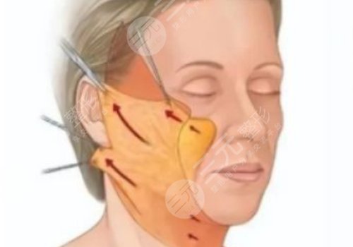 筋膜懸吊面部提升術(shù)恢復(fù)期多久？