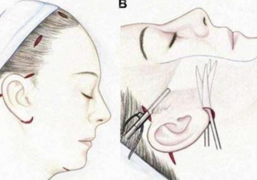 筋膜懸吊面部提升術(shù)恢復(fù)期多久？
