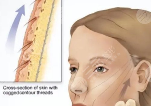 筋膜懸吊面部提升術(shù)恢復(fù)期多久？