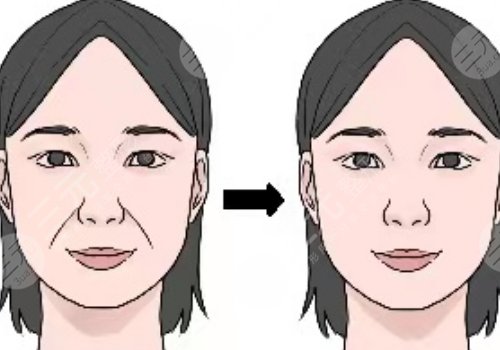 筋膜懸吊面部提升術(shù)恢復(fù)期多久？