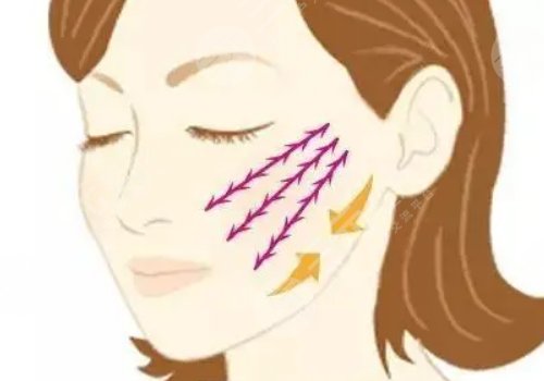 筋膜懸吊面部提升術(shù)恢復(fù)期多久？