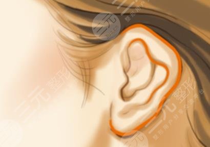 耳廓再造