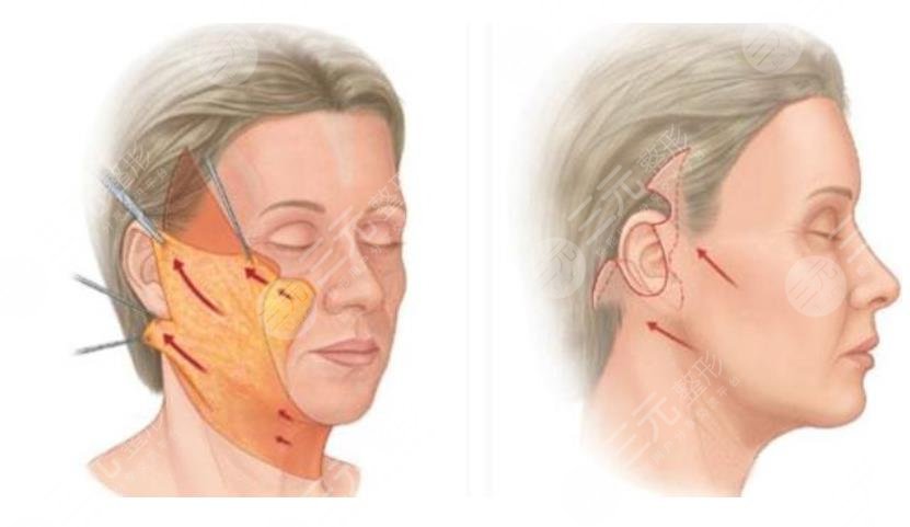 雙燕尾拉皮手術(shù)