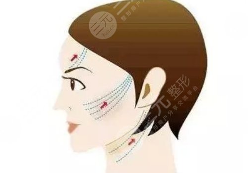 皺紋去除的好辦法是什么？