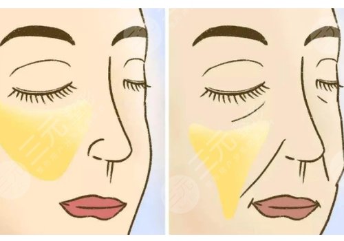 皺紋去除的好辦法是什么？