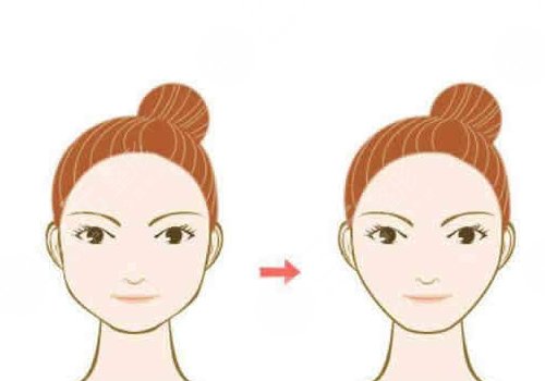 外輪廓固定怎么做多少錢