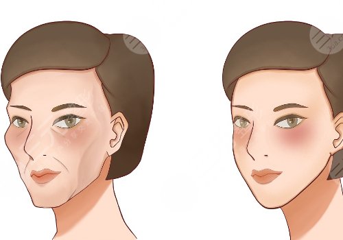 凹陷修復(fù)多少錢一個(gè)坑？