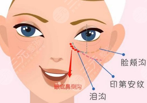 印第安紋是怎么形成的還能消除嗎