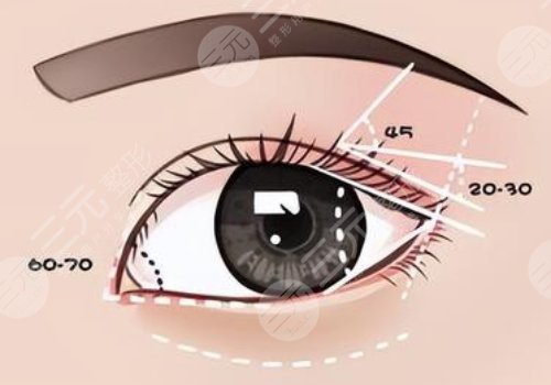 腫眼泡怎么消除？