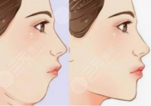 輪廓固定打什么針效果好一點(diǎn)