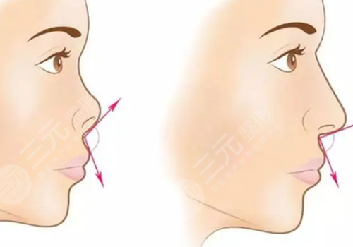 墊鼻基底前后對(duì)比