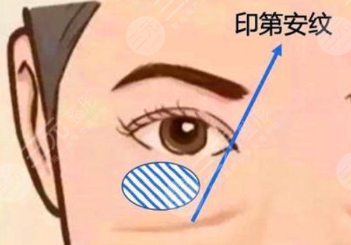 印第安紋和淚溝的區(qū)別是什么？