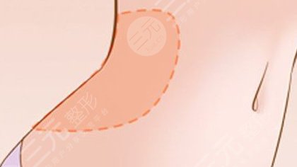 腰腹環(huán)吸包括哪幾個(gè)部位？