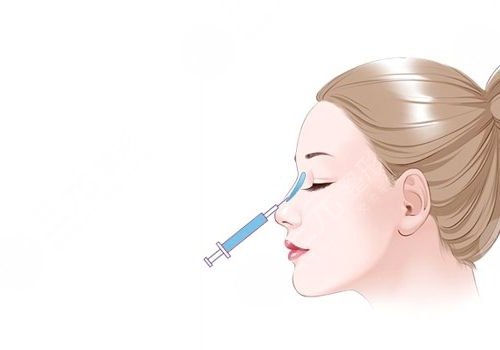 微調(diào)整形都有什么項(xiàng)目？