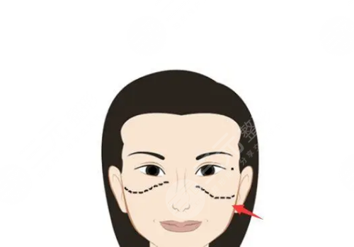 顴骨高有什么辦法改良