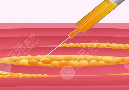 顴骨高有什么辦法改良