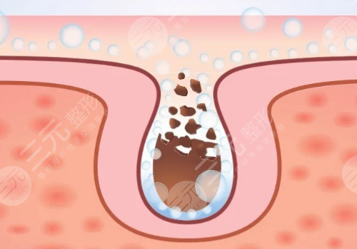 面頰毛孔粗大怎么辦？
