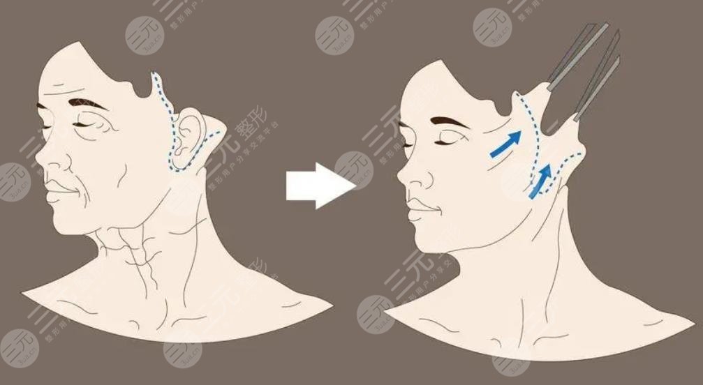 雙矢量提升術(shù)能維持多久