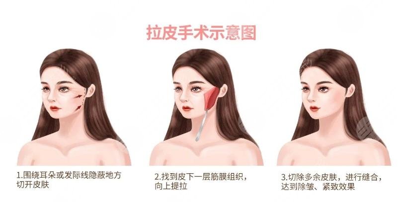 雙矢量組織復位術(shù)