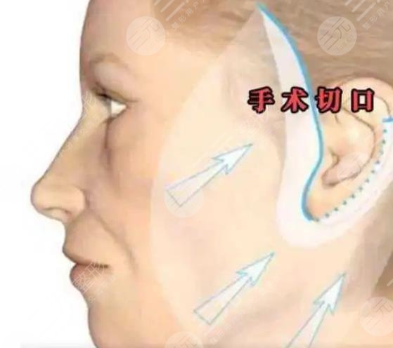 李曉東拉皮手術(shù)案例
