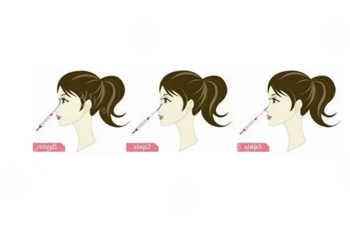 寶尼達隆鼻可以維持多久？