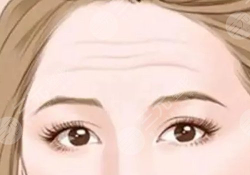 抬頭紋去除手術(shù)需要多少錢？