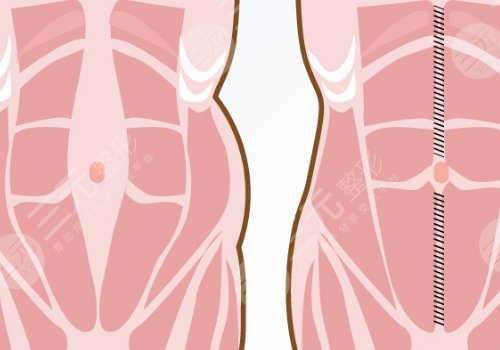 腹部拉皮手術(shù)多久能恢復(fù)正常？