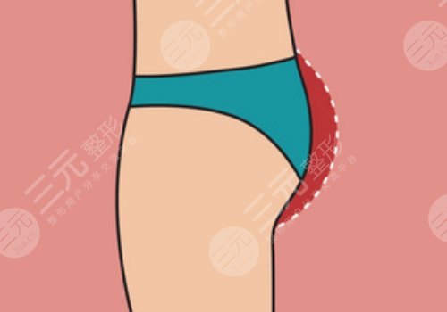 假體豐臀需要多少錢？