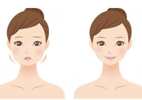 內(nèi)輪廓固定提升能保持多久時間？