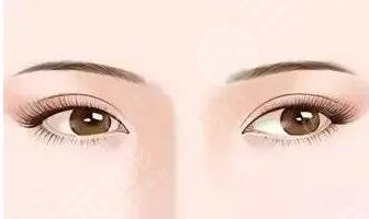 中國醫(yī)學(xué)科學(xué)院整形科雙眼皮案例