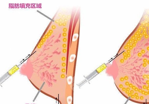 胸型不好看可以調(diào)整嗎？
