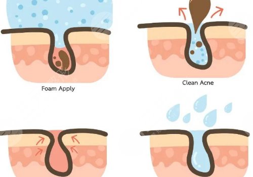 t區(qū)出油毛孔粗大怎么辦？