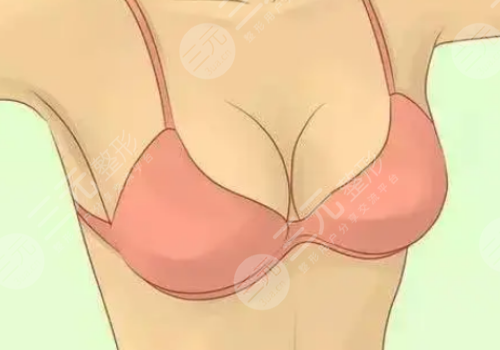 胸型外擴(kuò)怎么矯正