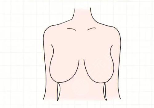 胸型外擴(kuò)怎么矯正