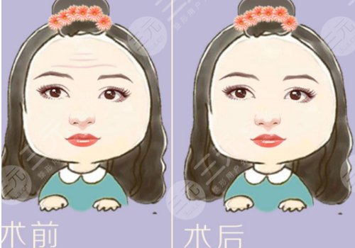 抬頭紋怎么去除？