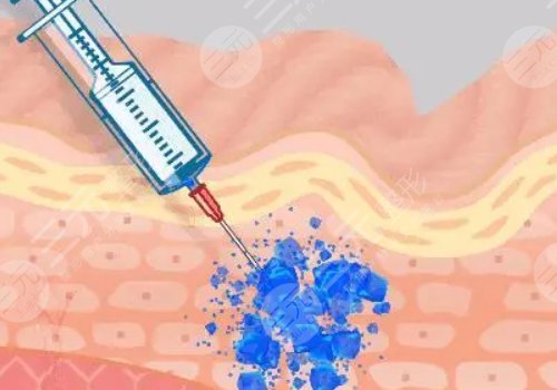 外輪廓固定提升有哪些手術(shù)方案？