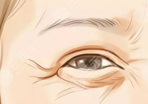 薇旖美可以注射眼部周圍的皺紋不？