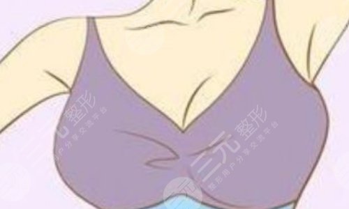 自體隆胸可以保持幾年？