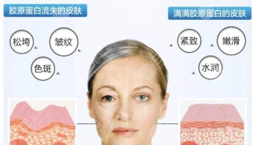 膠原蛋白注射臉部有副作用嗎?