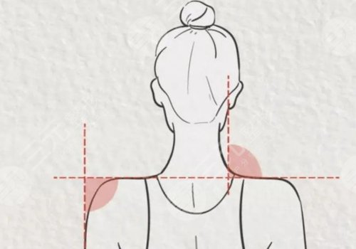 做直角肩多少錢？