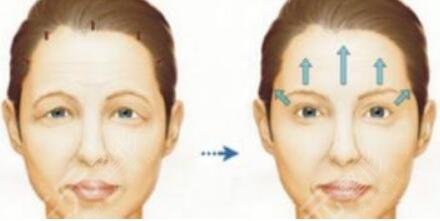 面部提拉緊致手術(shù)護(hù)理注意事項(xiàng)